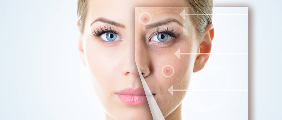 Stres Uzrokuje Akne U Odrasloj Dobi Istina Ili Mit Ordinacija Hr