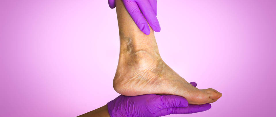 Slikovni rezultat za prosirene vene