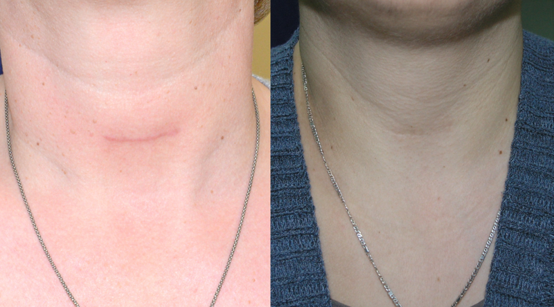 Znate Li Koje Su Najcesce Komplikacije Operacije Stitnjace Ordinacija Hr