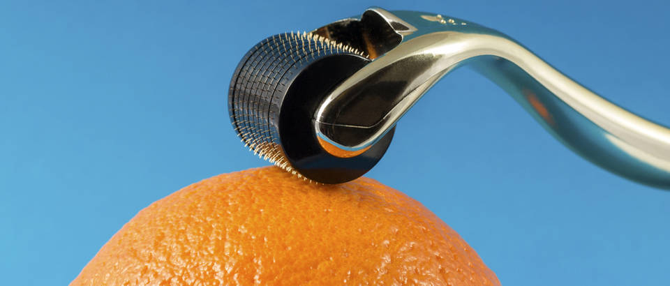 Mezoterapija shutterstock
