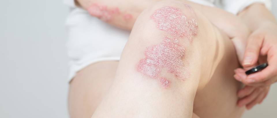 Psorijaza (9)