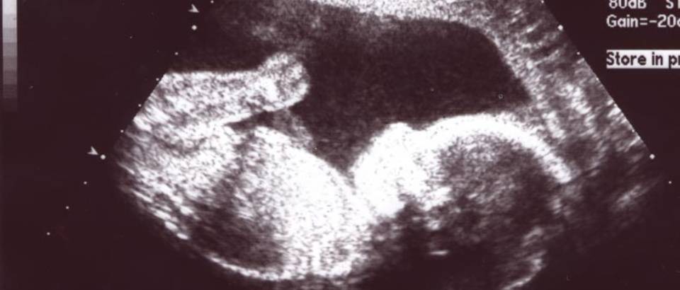 trudnoca ultrazvuk