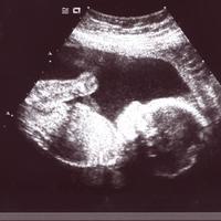 trudnoca ultrazvuk