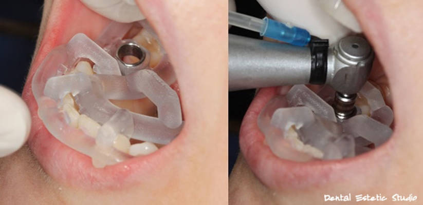 Dental cetar implantacija