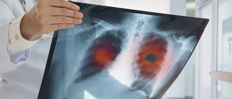 Virusne upale pluća: O njima se govori 