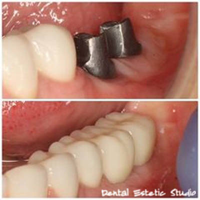 Dental cetar 3