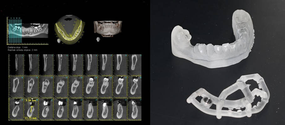 Dental cetar CT+ŠABLONA