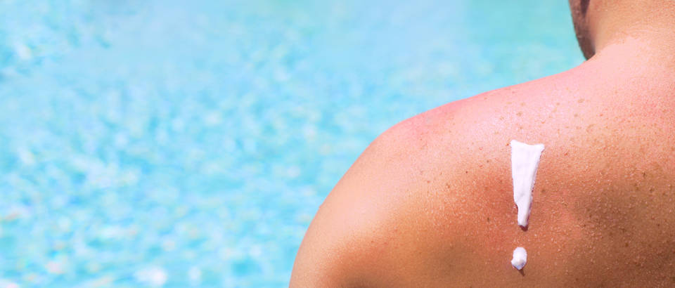 Shutterstock sunce koza suncanje opekline ljeto muskarac kupanje rame ruka ledja pjege madezi 285665030