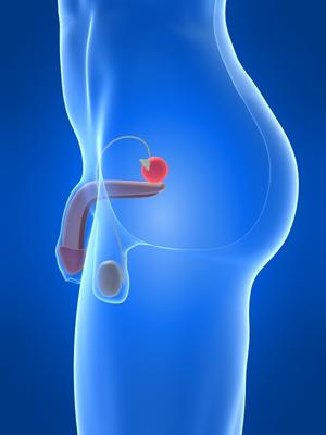 prostate bol zbog karcinoma u zglobovima