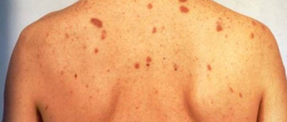 kaposi-daviddarling.info-Kaposis_sarcoma