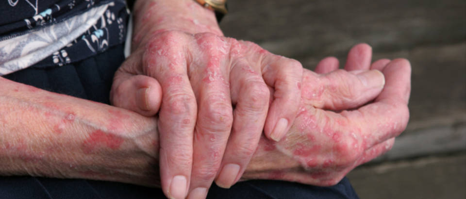 starica, dermatitis, lisaj, ekcem