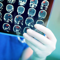tumor mozga, Shutterstock 390249514