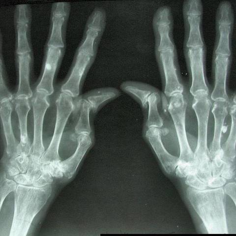 artritis, artroza uređaji za pročišćavanje longidaza bol u zglobovima