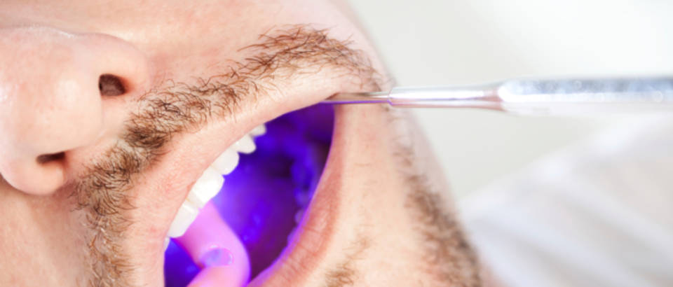 zubni kamenac, stomatolog, zubi, pregled, ultraljubicasto svjetlo