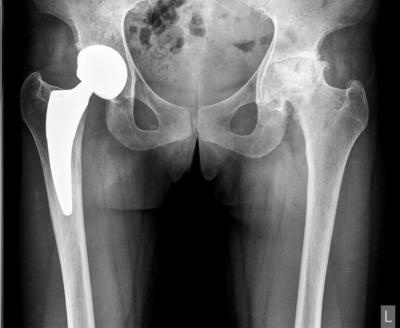 katara bol u zglobovima artroza koljena košta liječenje