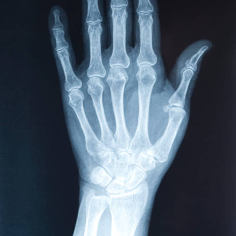 bol u rukama zglob bilja za liječenje osteoartritisa
