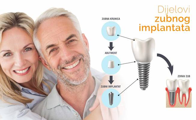 Nadomjesti zub implantatom