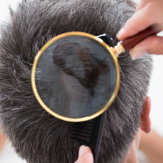 Najbolji &scaron;amponi protiv peruti: Dermatolozi otkrili pet moćnih formula koje zaista djeluju