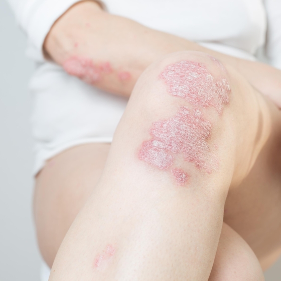 Revolucija u liječenju psorijaze: Može li prehrana doista ublažiti bolne simptome?