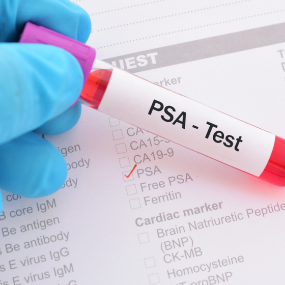 Jelovnik za vrijeme zračenja prostate: Koja hrana pomaže?